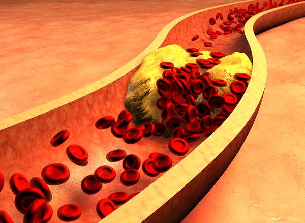 illustration of arteries being clogged by bad ldl cholesterol